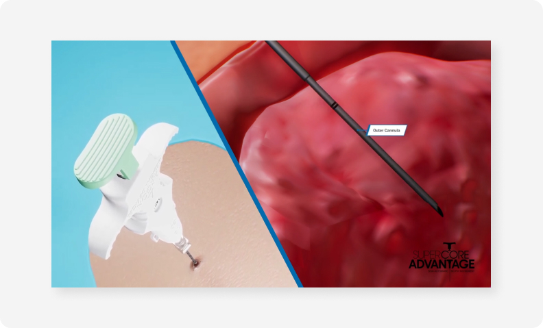 Argon Medical case study